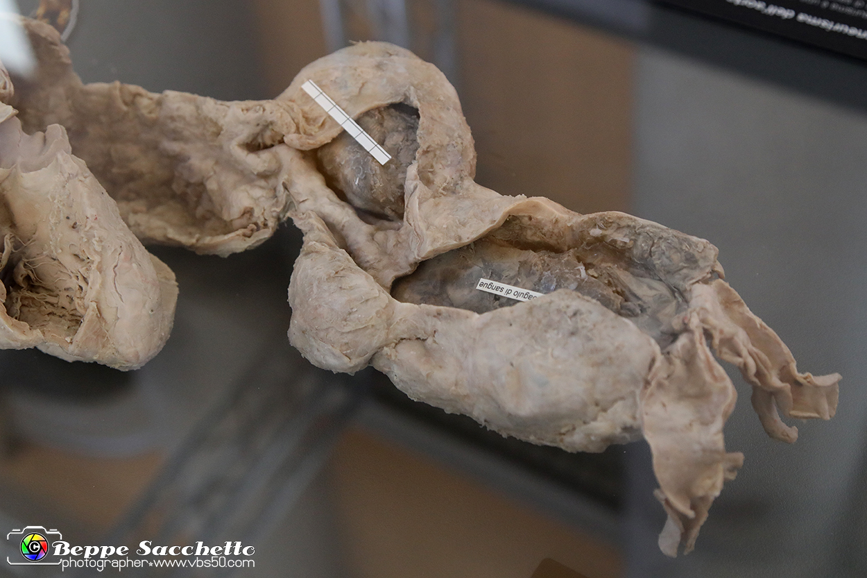 VBS_2790  - Aneurisma dell'aorta - Mostra Body Worlds.jpg